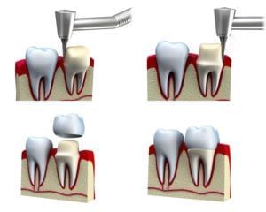 Diagram showing how a tooth is prepared for a dental crown