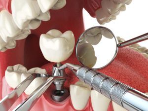 Dental implant placement procedure