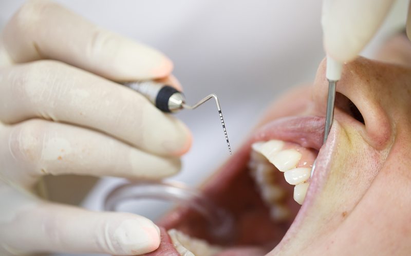 The Pinhole Surgical Technique » Santa Ana, CA Sunset Dental Group