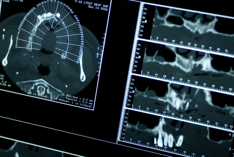 CT Dental Tomography