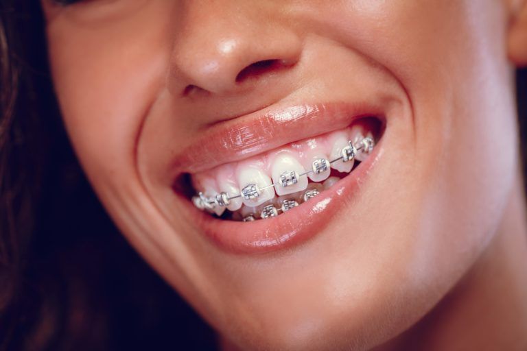 Different Types Of Braces Santa Ana Ca Sunset Dental Group