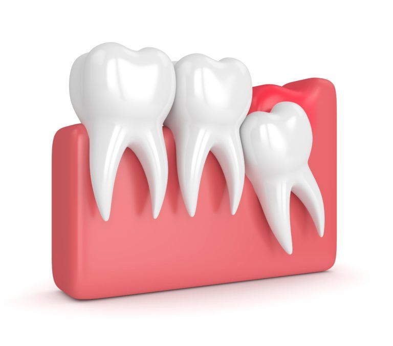 What Does It Mean For A Tooth To Be Impacted? » Santa Ana, CA - Sunset ...