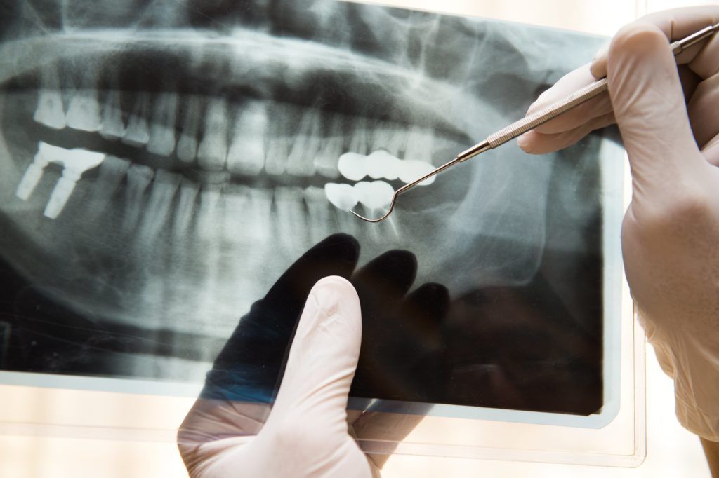 Are Dental XRays Safe? » Santa Ana, CA Sunset Dental Group