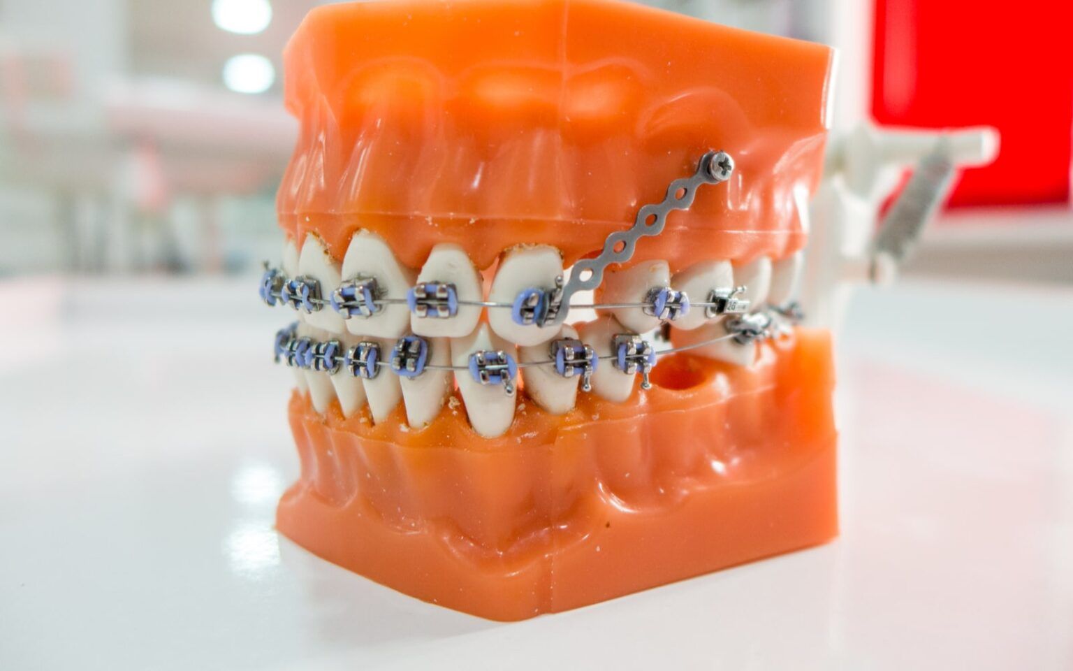 What is The Orthodontic Anchorage Technique? » Santa Ana, CA - Sunset ...